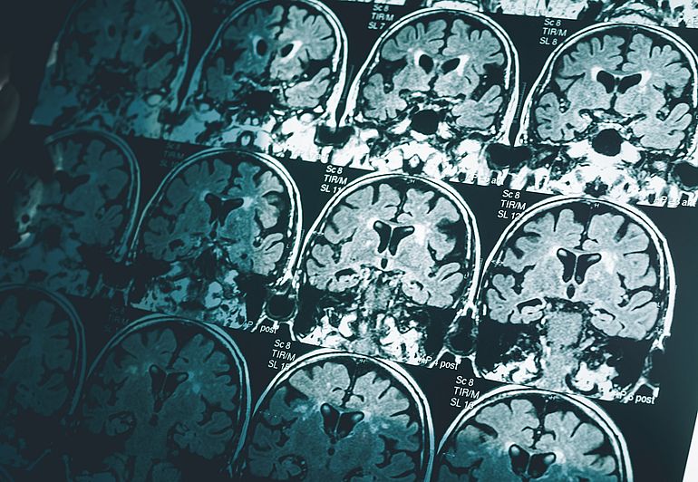 Esperanza ante el nuevo fármaco que frena el deterioro cognitivo en alzhéimer