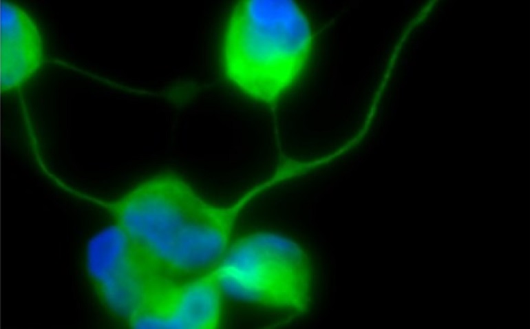 Generan neuronas mediante reprogramación directa de las células de la piel de pacientes mitocondriales con el síndrome MELAS