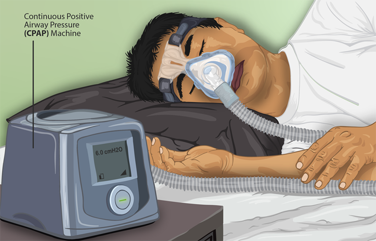 La apnea obstructiva del sueño multiplica hasta por tres el riesgo