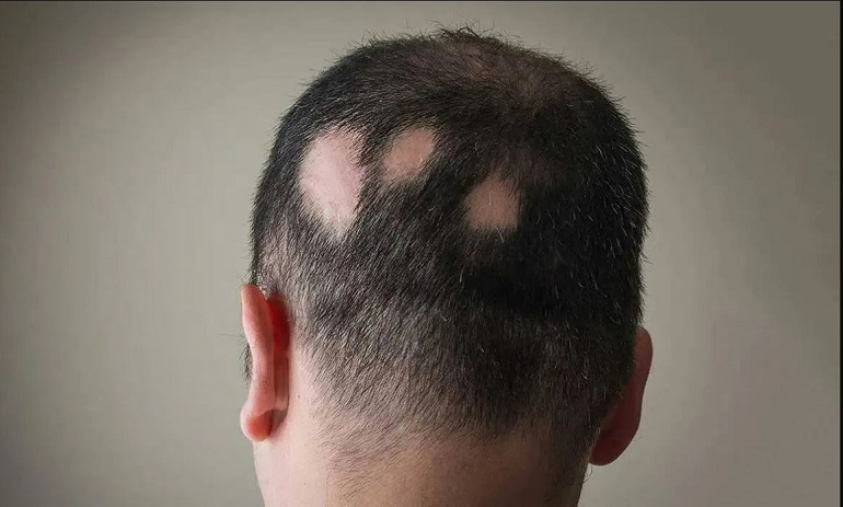 Demuestran que padecer alopecia areata se asocia con un tipo de personalidad