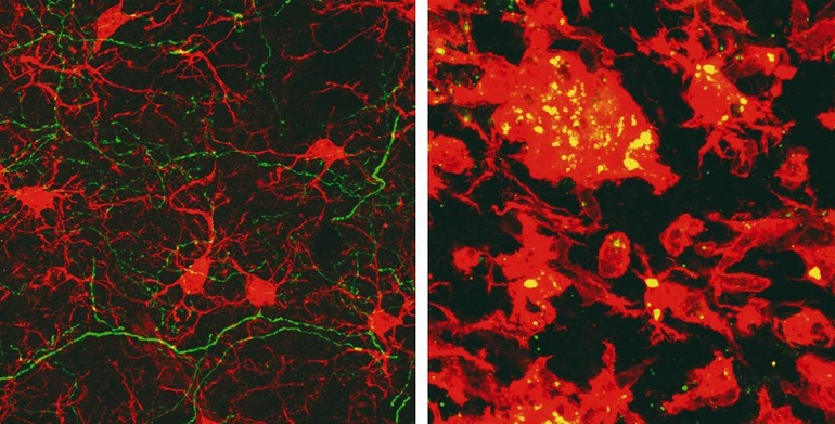 La inflamación en la enfermedad de Parkinson varía según la región cerebral