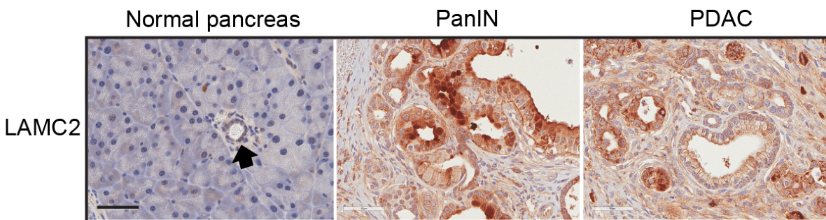 Identifican un gen clave en el desarrollo y tratamiento del cáncer de páncreas más común