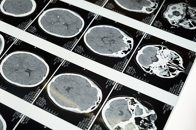 Inteligencia artificial para calcular el riesgo de alzhéimer según la edad del cerebro