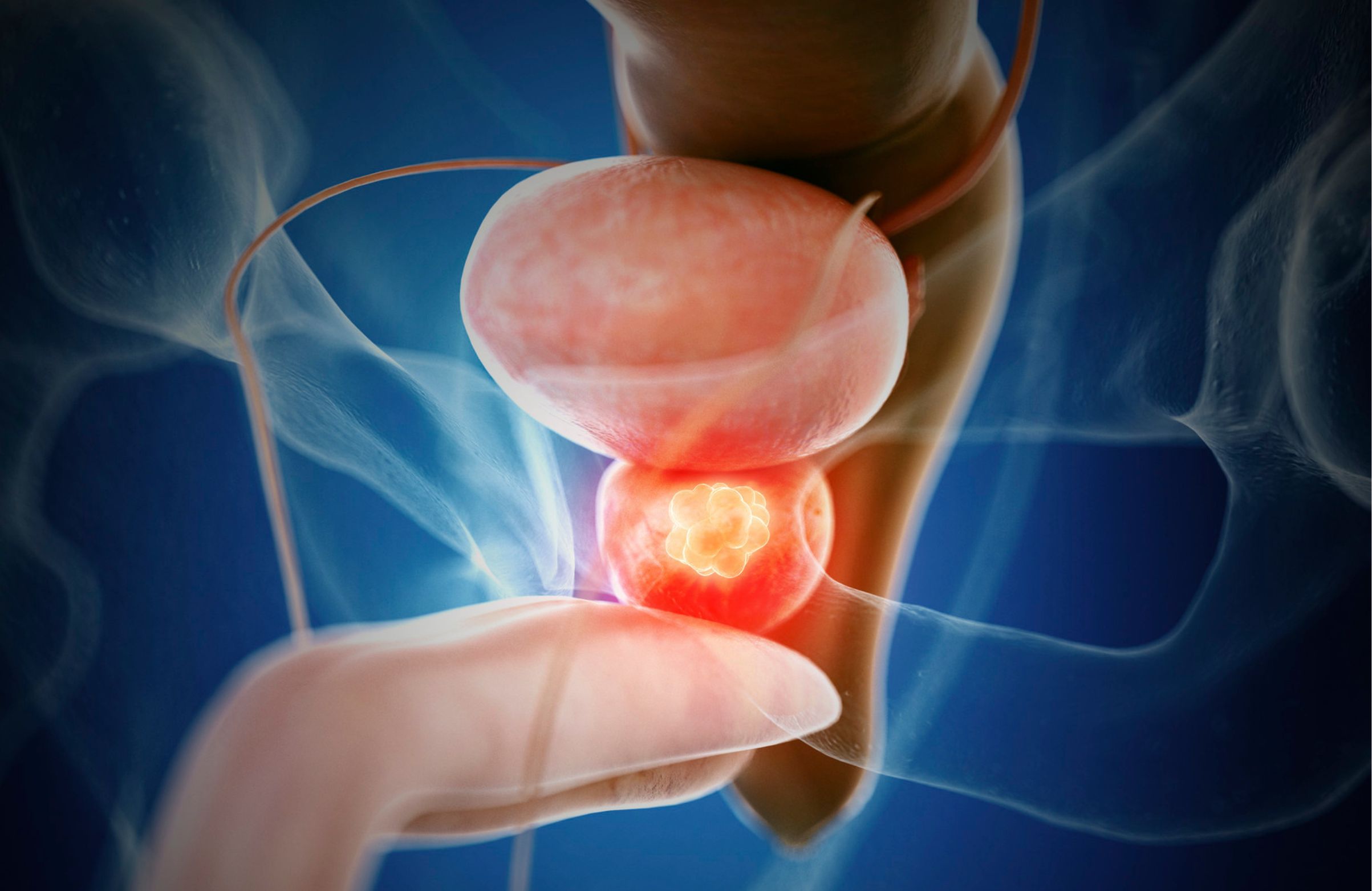 Cáncer de próstata avanzado: la supervivencia se triplica en 15 años