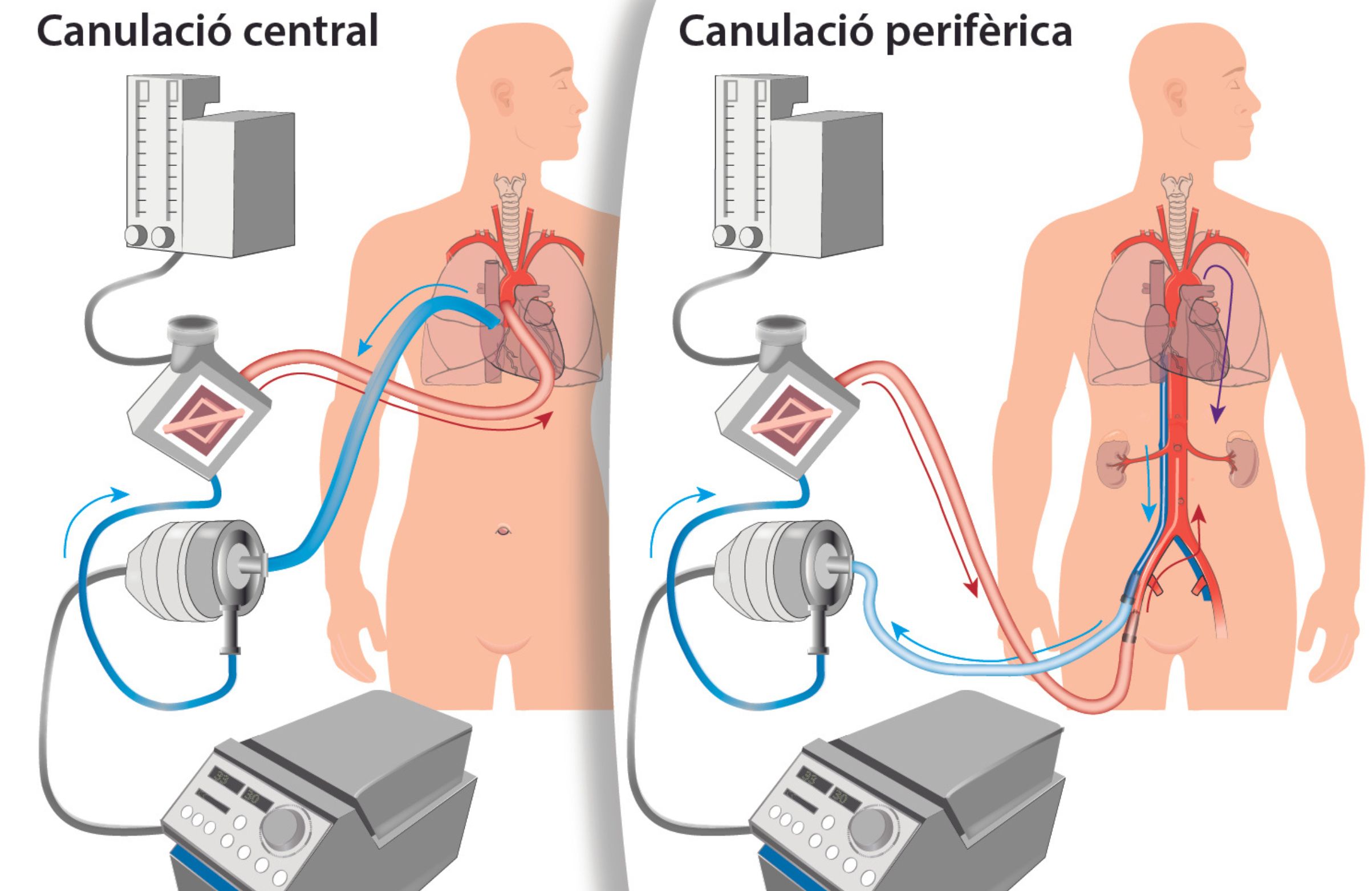 El HUB ha estudiado cómo reducir el impacto de una de las principales complicaciones de los trasplantes cardiacos