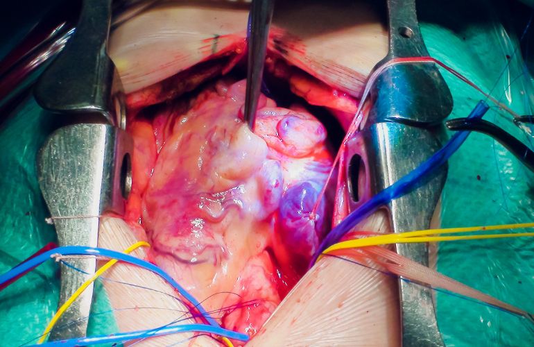 El HUB ha estudiado cómo reducir el impacto de una de las principales complicaciones de los trasplantes cardiacos