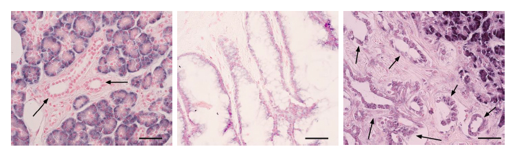 ¿Qué investigación se realiza en cáncer de páncreas?