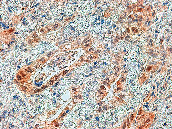 Nueva v&iacute;a para atacar al adenocarcinoma de pulm&oacute;n que podr&iacute;a mejorar los tratamientos actuales