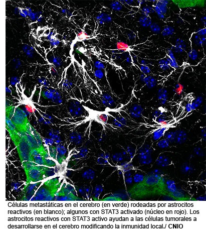 Una nueva terapia muestra su eficacia frente a la met&aacute;stasis cerebral