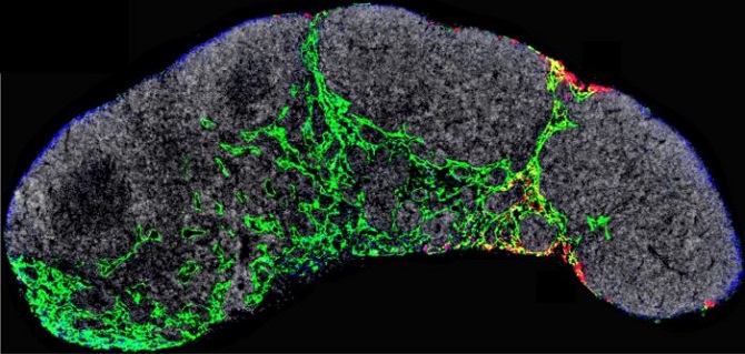 Descubren un mecanismo involucrado en el inicio de la metástasis del melanoma