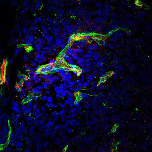 Nuevo biomarcador para predecir la eficacia de la inmunoterapia en c&aacute;ncer