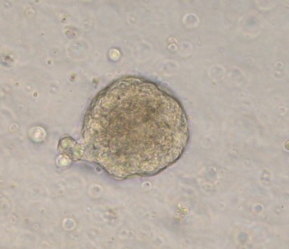 Nuevo f&aacute;rmaco como potencial tratamiento de c&aacute;ncer de mama en mujeres j&oacute;venes, m&aacute;s agresivo y de peor pron&oacute;stico