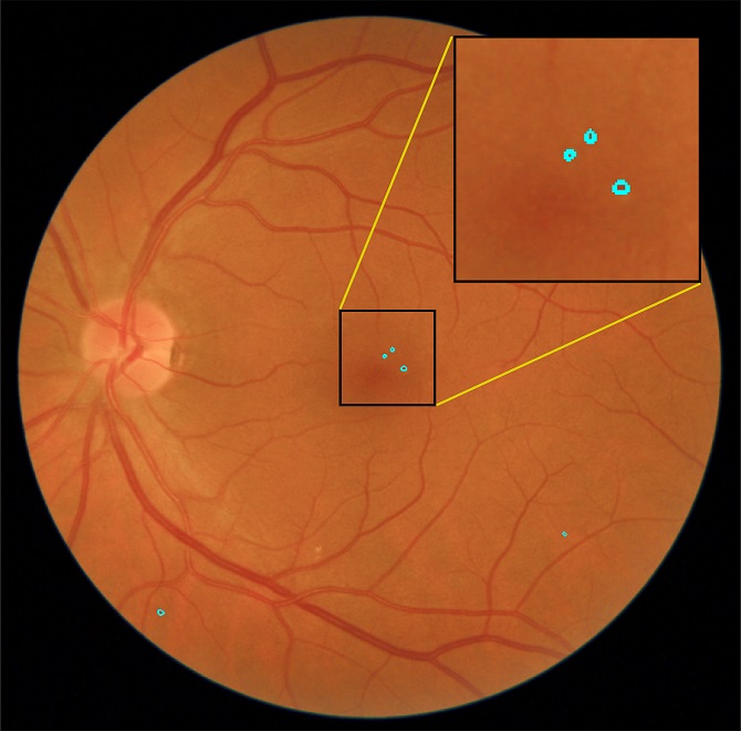 Un sistema autom&aacute;tico para detectar lesiones rojas en la retina
