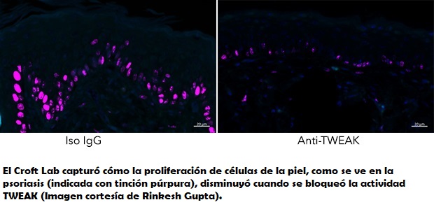 Nueva diana terapéutica contra la psoriasis