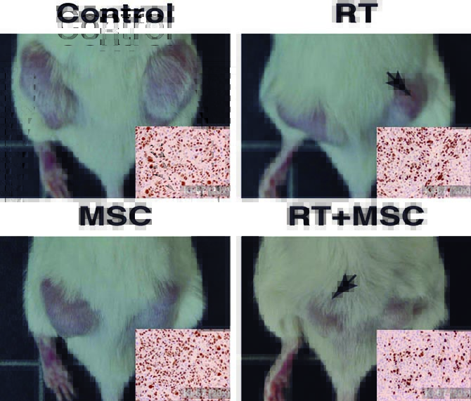 Demuestran el potencial terap&eacute;utico de las c&eacute;lulas madre combinadas con radioterapia contra el c&aacute;ncer