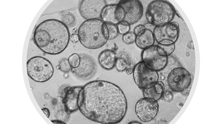 ¿Qué investigación se realiza en cáncer de páncreas?