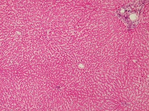 Descubren la prote&iacute;na causante de un mayor riesgo de infecci&oacute;n bacteriana y de muerte tras un trasplante de h&iacute;gado