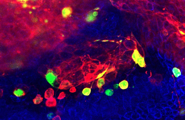 La inestabilidad cromosómica de las células cancerosas favorece la invasividad al dañar el ADN