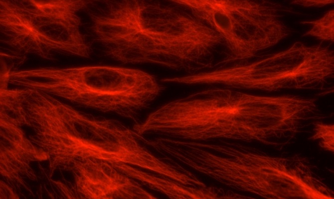 COVID-19 como enfermedad cardiovascular: en busca de biomarcadores para identificar precozmente los casos graves