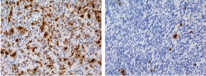 Células de glioma (en azul) bajo tratamiento con temozolomida, con daño en el ADN marcado en color marrón. Cuando el locus de MGMT está intacto, su expresión se silencia y la temozolomida promueve el daño del ADN en todas las células tumorales (izquierda); Cuando se reorganiza el locus de MGMT, las células de glioma sobreexpresan MGMT, pueden reparar el daño y seguir creciendo (derecha). /CNIO Un equipo de científicos descubre cómo algunos gliomas adquieren resistencia a la quimioterapia