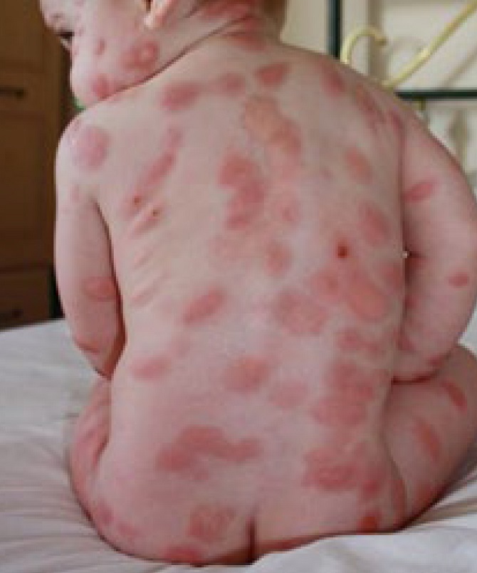 Pacientes de mastocitosis denuncian el deterioro del centro de referencia nacional de Toledo