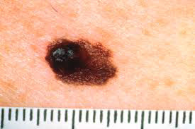 Aplican la inteligencia artificial para visualizar datos gen&eacute;ticos de pacientes con melanoma