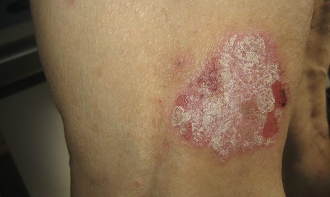 La psoriasis mejora en verano gracias al sol, pero &laquo;tambi&eacute;n existen riesgos&raquo;