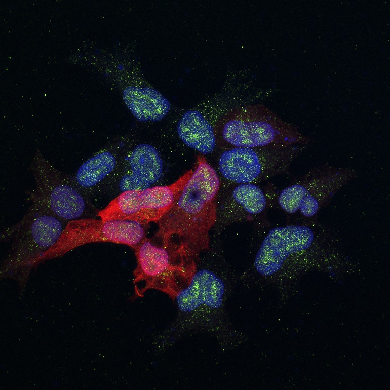 Descifrado el mecanismo por el cual una proteína favorece la metástasis del cáncer de mama