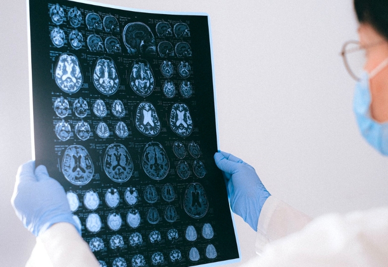 Identifican nuevos marcadores para diagnosticar el alzhéimer de forma precoz