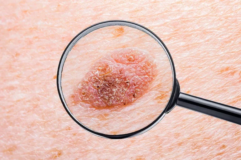 Diagnóstico de forma temprana del cáncer de piel más agresivo mediante biopsia líquida