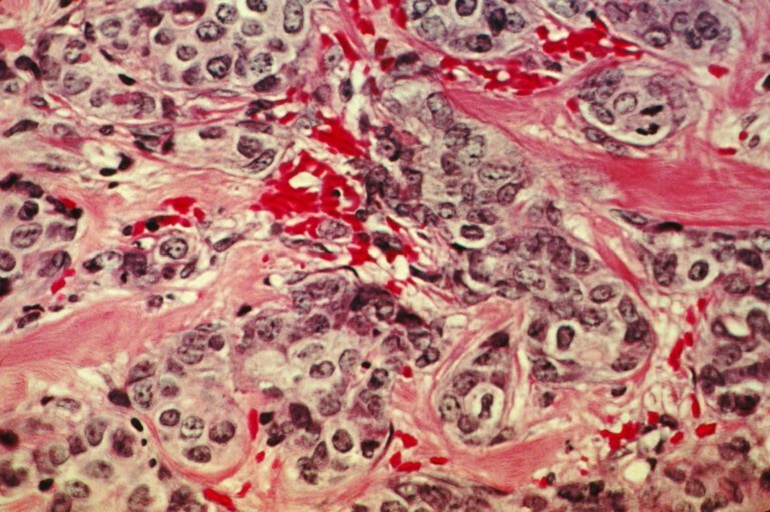 Un estudio confirma la fibrosis como indicador pronóstico en cáncer de mama y abre la vía a tratamientos con fármacos antifibróticos