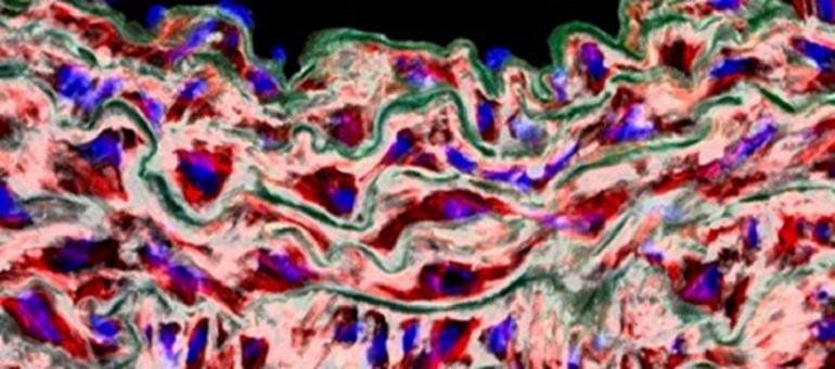 Descubren una nueva causa de los aneurismas de aorta y una posible vía para prevenirlos sin cirugía