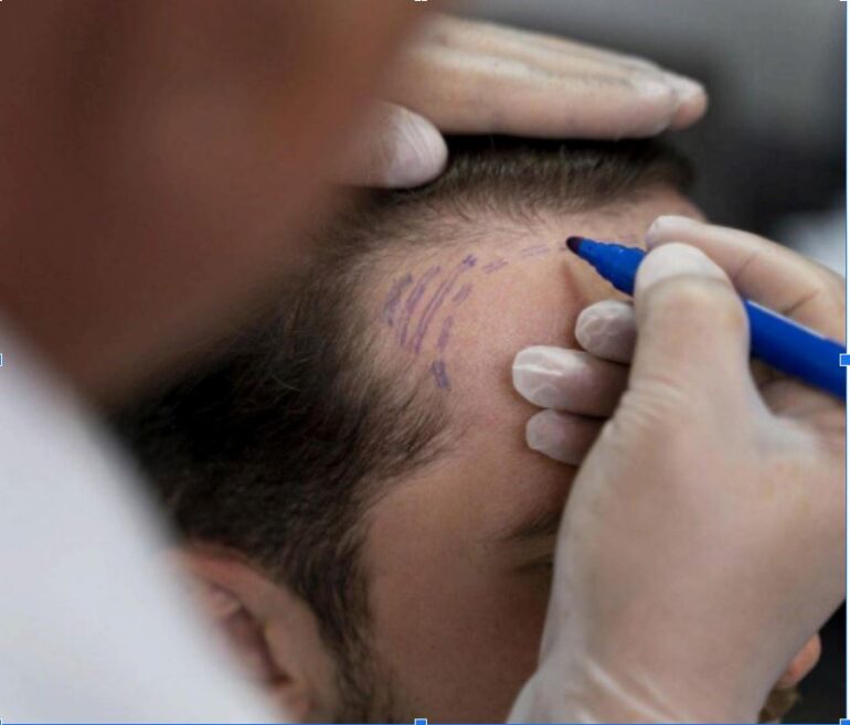Tratamientos capilares en Clínica Ferraro: trasplante capilar y estética avanzada en ABC Serrano