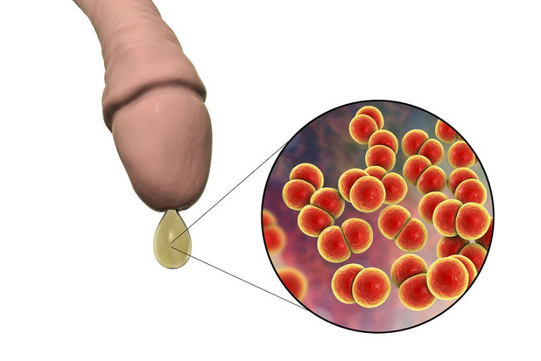 Un nuevo tratamiento oral de dosis única combate eficazmente la gonorrea