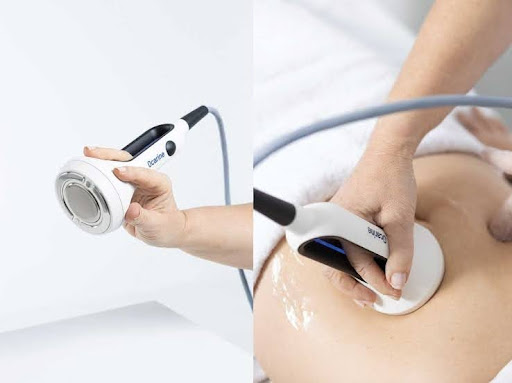 Ocarine, el aparato de remodelación corporal favorito en los centros médico-estéticos