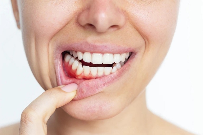Enfermedad periodontal: qué es, por qué avanza en silencio y cómo se relaciona con la salud general