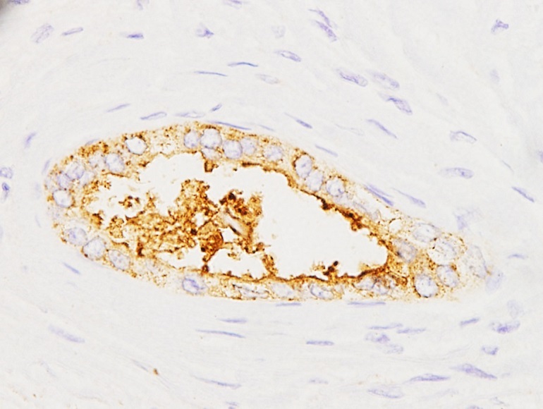 Desarrollan un prototipo de test diagnóstico para detectar el cáncer de páncreas en minutos con una muestra de sangre