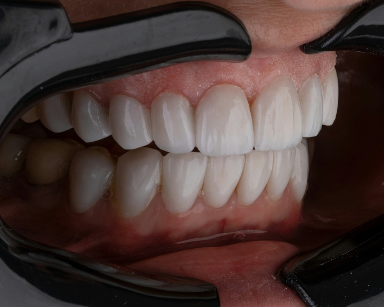 Cobertura dental en el seguro de salud: qué incluye y cómo utilizarla