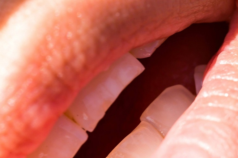Gingivitis y periodontitis: cómo reconocer los primeros síntomas