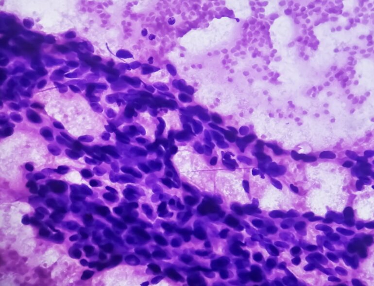 Un fármaco utilizado en el posparto podría reducir el riesgo de cáncer de mama