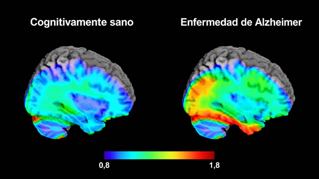 La edad del habla: lo que la voz humana revela sobre el envejecimiento cerebral