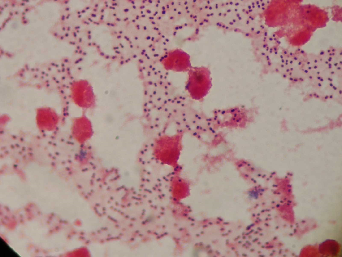 Cincuenta años de datos permiten reconstruir con la genómica cómo han cambiado el neumococo, las resistencias y la meningitis
