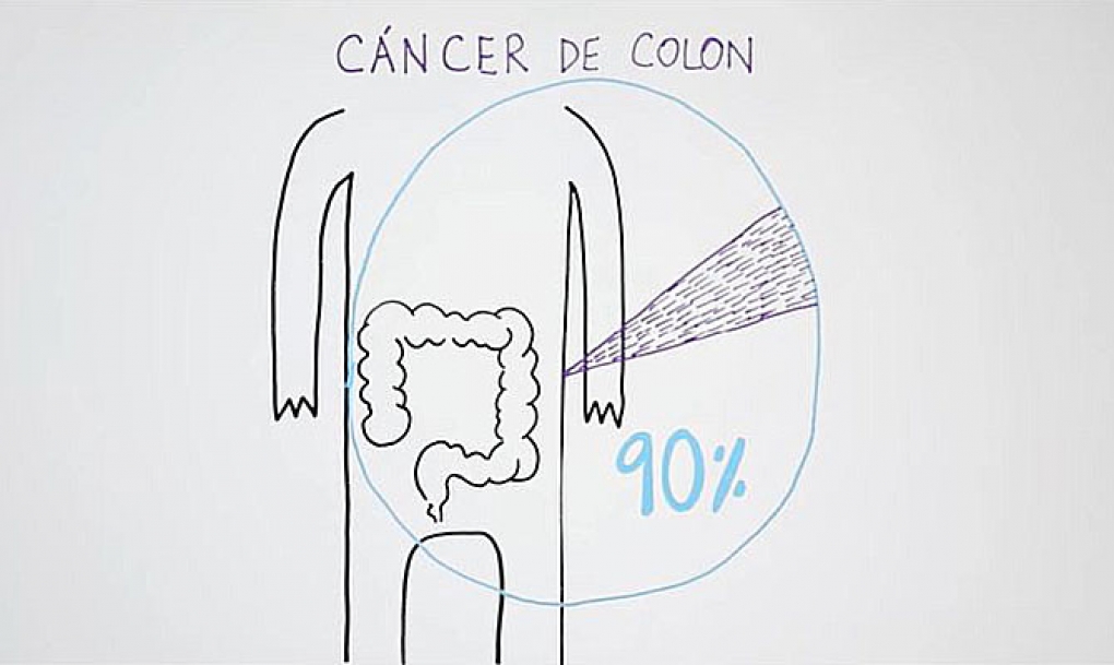 La edad, los antecedentes familiares y otros tumores o síndromes hereditarios, principales factores de riesgo del cáncer de colon