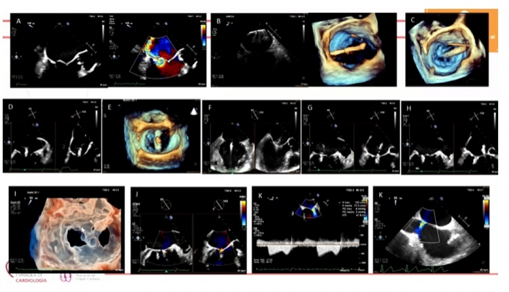 Las técnicas de imagen cardiaca, ‘aliadas’ de los cardiólogos en el diagnóstico de la covid persistente