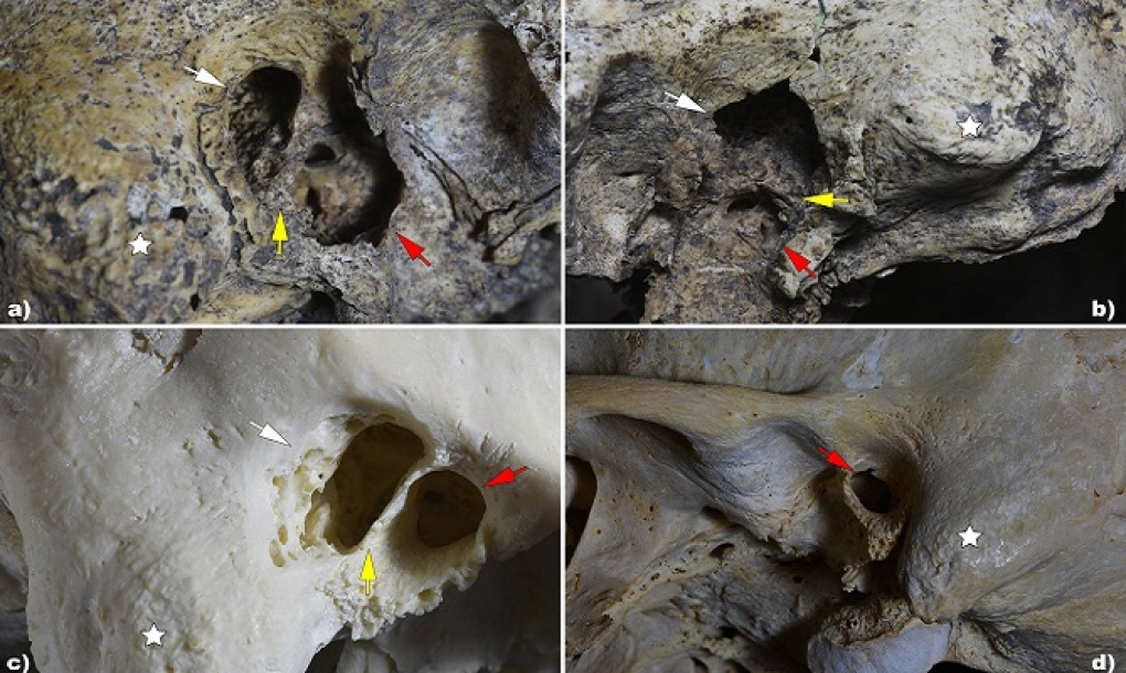Documentada la primera cirugía otológica de la historia en el dolmen ‘El Pendón’, con más de 5.000 años