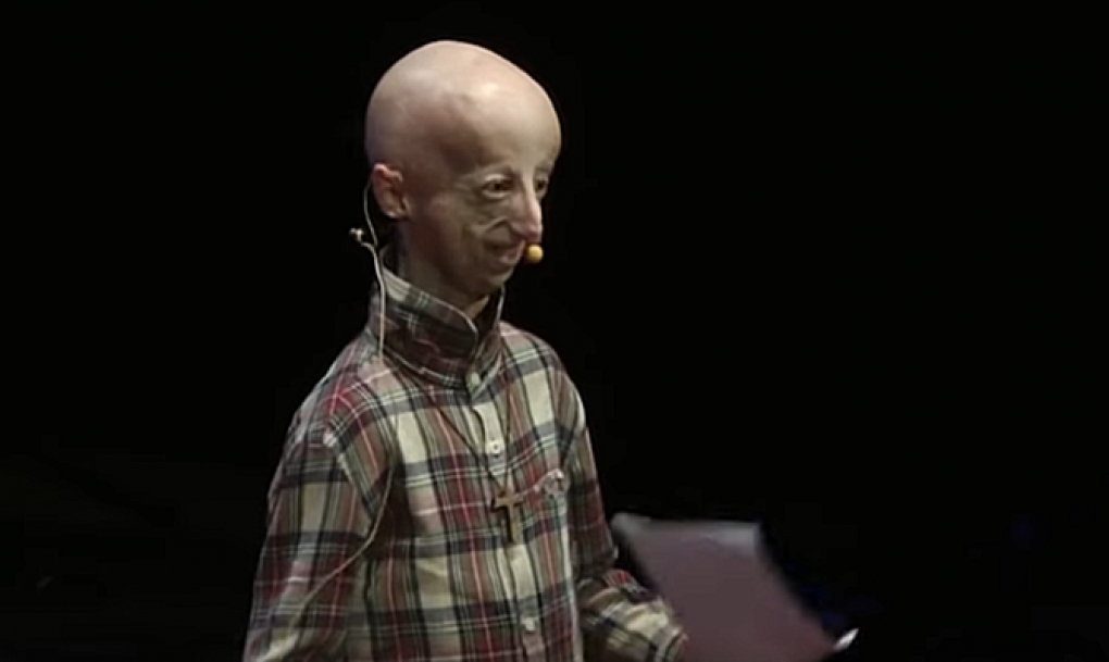 Nueva terapia contra la progeria, que causa envejecimiento acelerado en niños