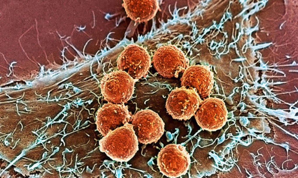 Defensas editadas con CRISPR muestran su seguridad en pacientes con cáncer