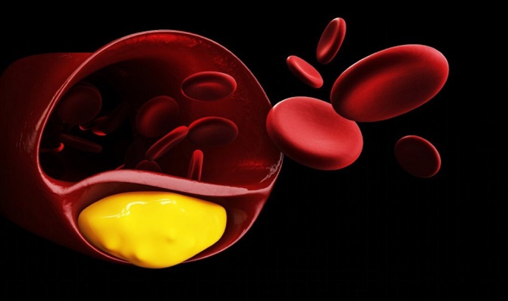 Lipoproteína (a): un tipo de colesterol “malo” genético que afecta a 1 de cada 5 personas en todo el mundo