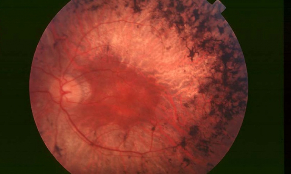 Los afectados por retinosis pigmentaria piden un mapa de centros sanitarios con Unidades de Retina y más investigación