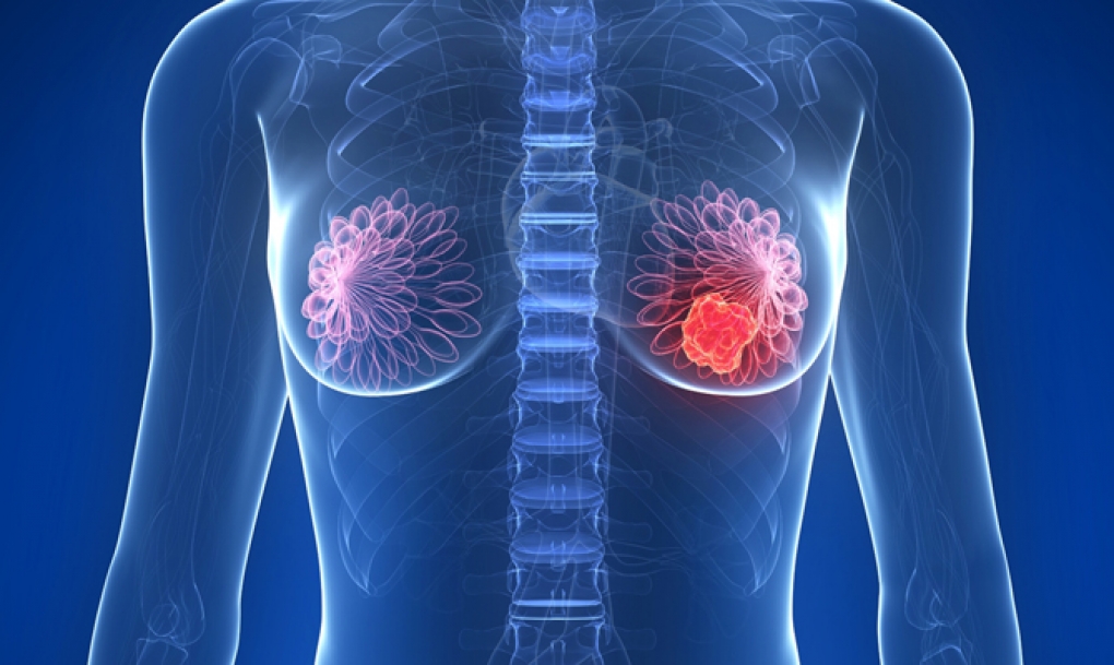 Nuevo método de análisis para adelantar la respuesta a un tratamiento contra el cáncer de mama